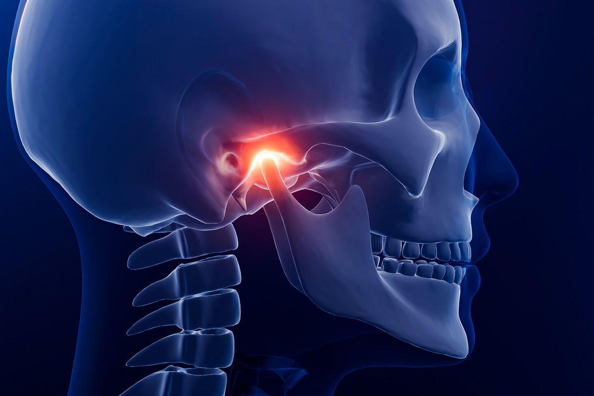 TMJ migraine image
